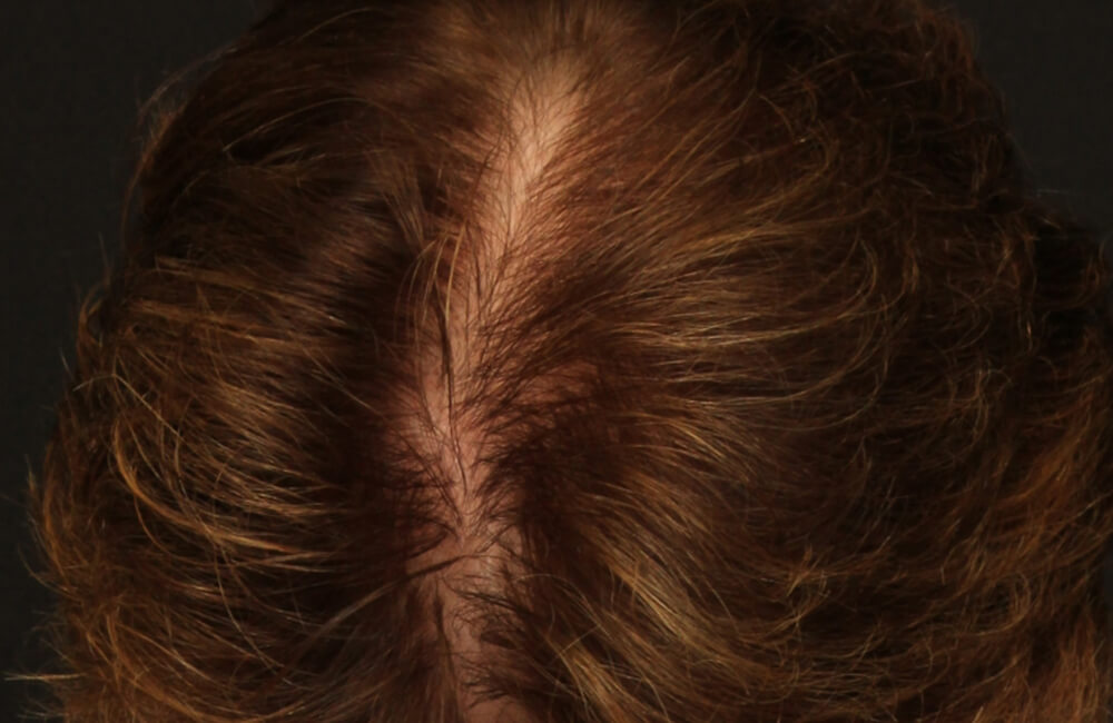 Female Hair Restoration - After