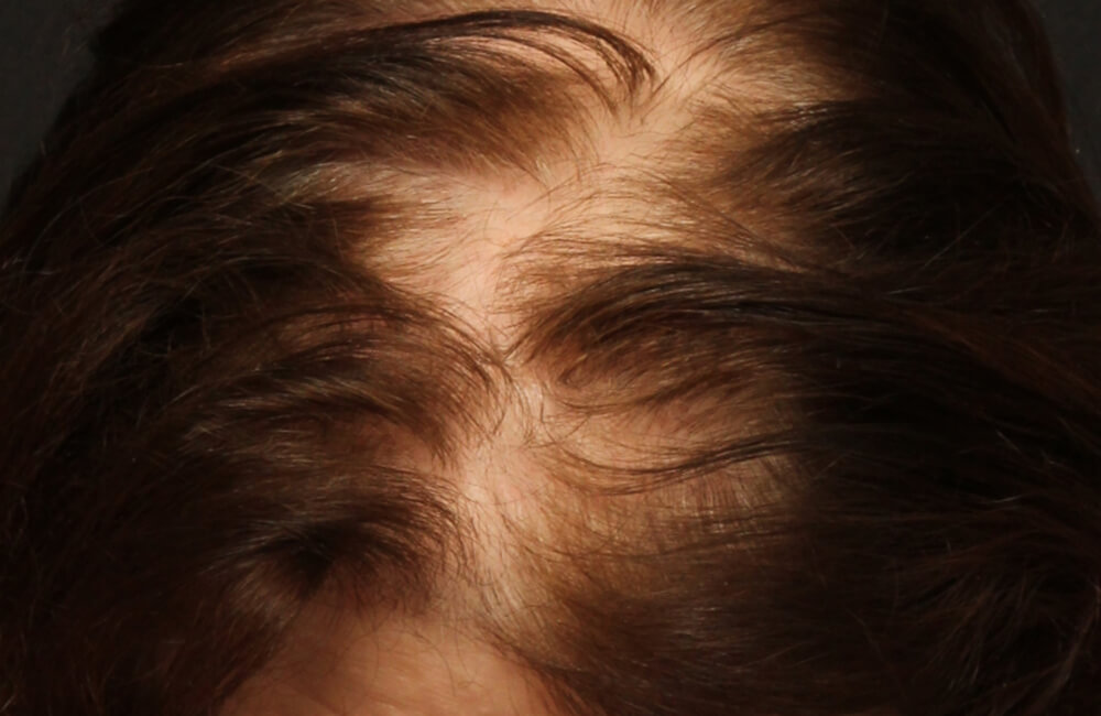 Female Hair Restoration - Before