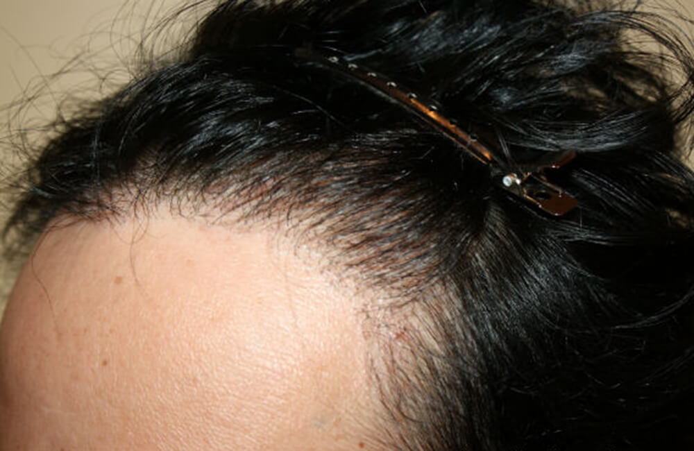 Male Hair Restoration - After